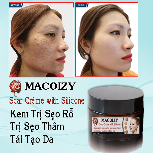 [HCM]Kem Xóa Sẹo Rỗ Macoizy Trắng Da Đầy SẸO RỖ