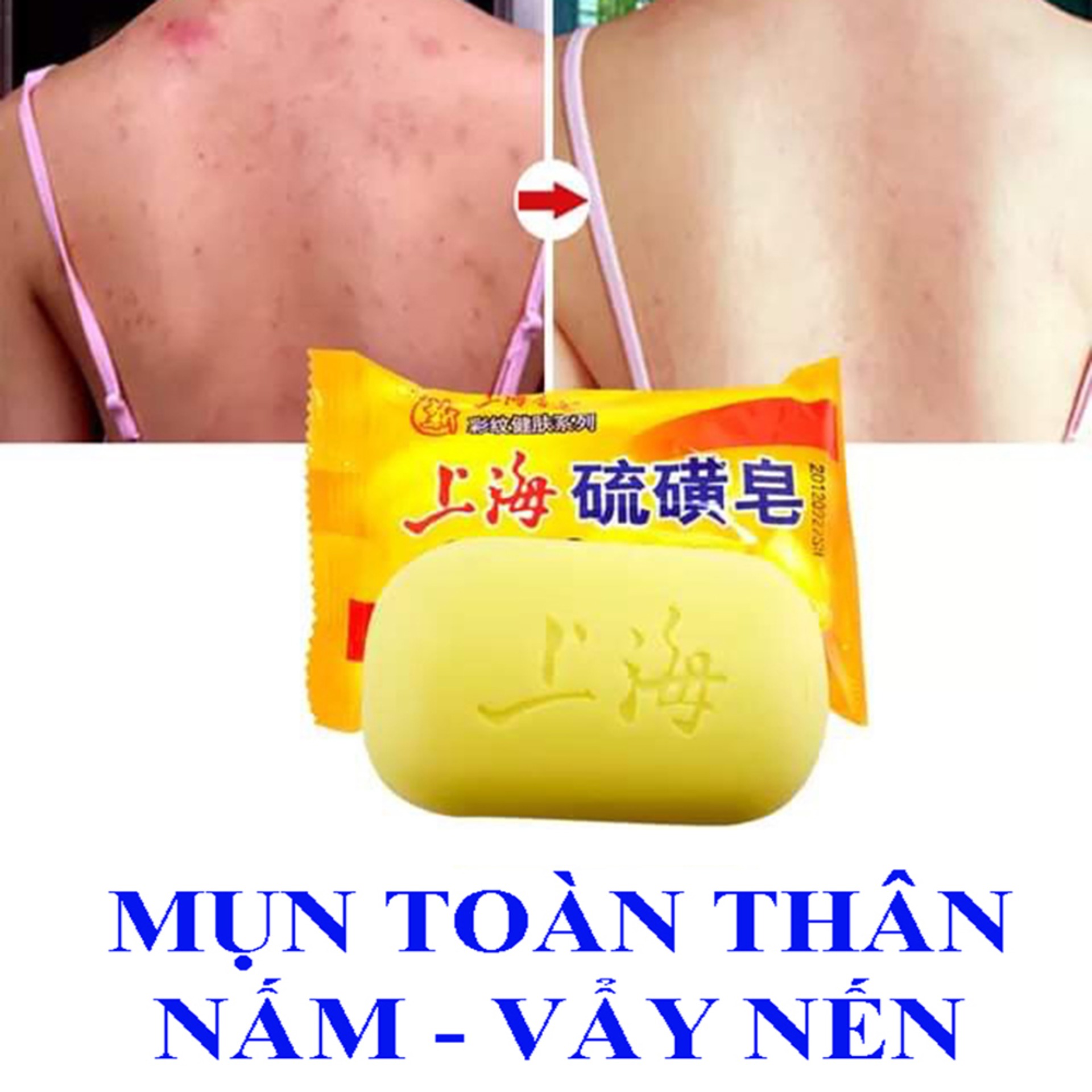 Xà phòng tắm mụn toàn thân-Viêm nang lông, nấm ngứa