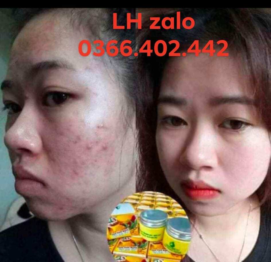 [FreeshipMAX] CAO NGHỆ NGÂN BÌNH (loại bỏ thâm, mụn, nám ,tàn nhang ,lỗ chân lông to ,làm trắng da...)