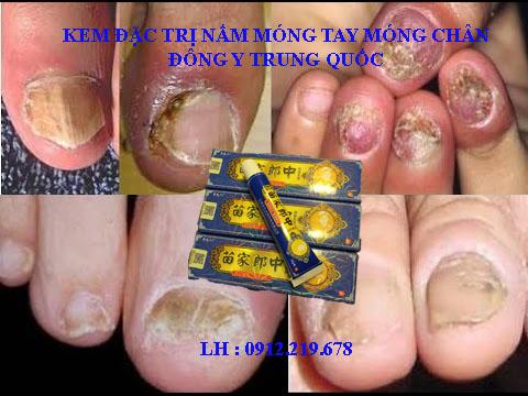 Kem bôi nấm móng tay móng chân nội địa trung