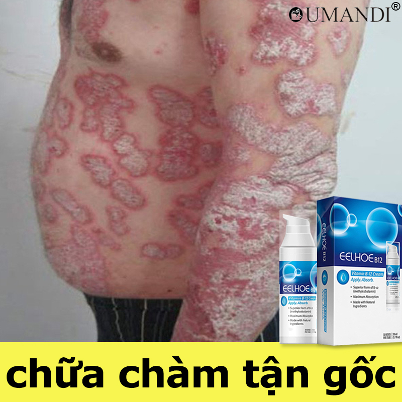 Cấp độ quân đội Đức dùng là hết bệnh OUMANDI ngứanấm danấm da đầu sau 7 ngày chống ngứa viêm daKem bôi vẩy nếnviêm da kháng khuẩn đánh bay nấm da nấm lang ben hắc lào mẩn ngứa rôm sảy viêm da cơ địaá sừngmề đay