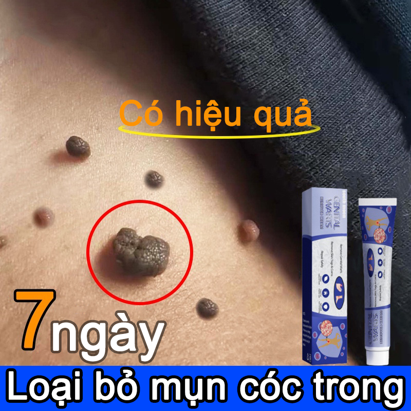 Kem xóa rốt ruồi Tẩy nốt ruồi tàn nhang mắt cá,mụn cóc mụn thịt handmade rất hiệu quả không làm sẹo da sẹo rỗ lâu năm các loại sẹo mụn trâu WART