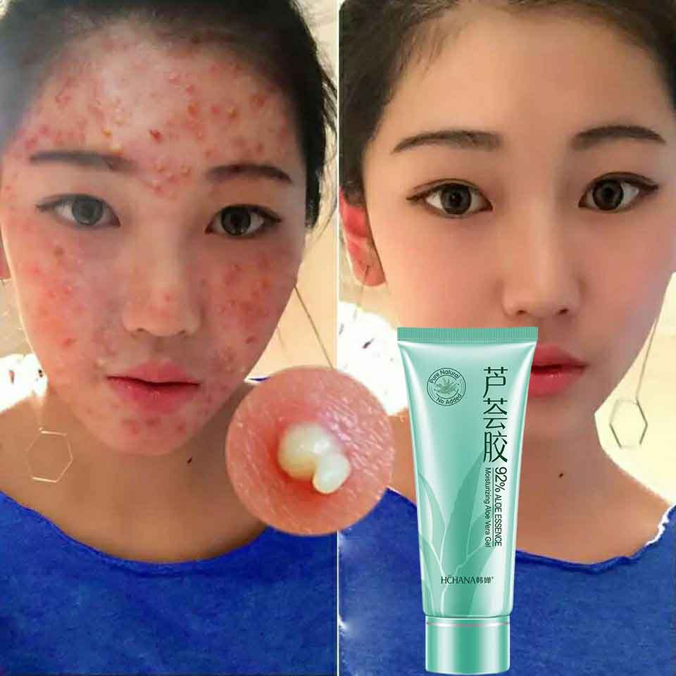 Gel lô hội kem nặn mụn, mụn,vết mụn, mụn ổ gà kem nặn mụn , gel bổ nước dưỡng ẩm, kem phục hồi sau nắng, kem gel phục hồi dịu nhẹ và không gây kích ứng 40g