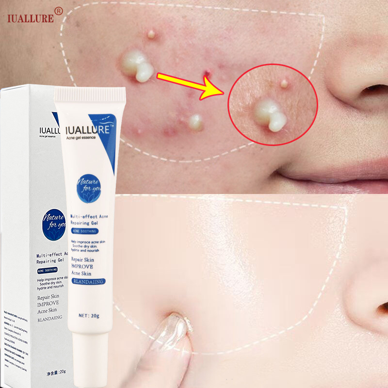 Kem Hết Mụn skin acne gel mụn Kem chấm mụn thâm cấp tốc cho nam giới nữ giới Xóa thâm Kem mụn giúp dưỡng trắng da xóa thâm liền sẹo Kiểm Soát Dầu Dưỡng ẩm và Nuôi giảm vết thâm mụn