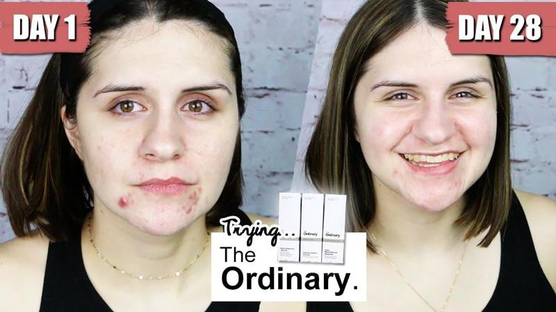 [HCM]Tinh Chất Giảm mụn The Ordinary Salicylic Acid 2% Solution