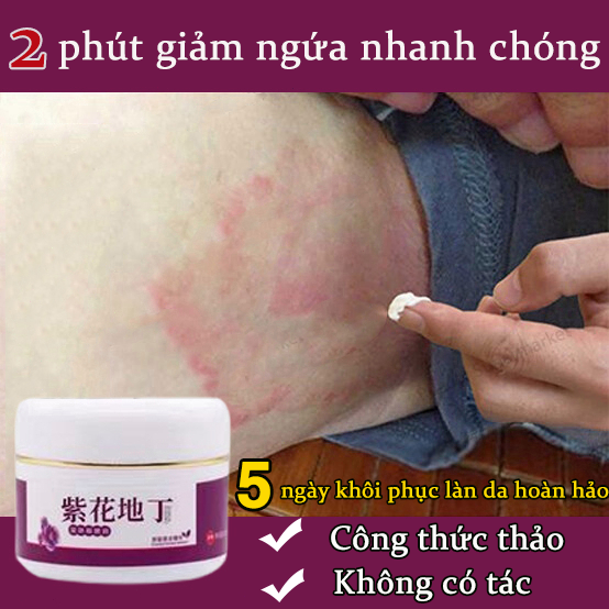 Kem giảm ngứa kem vảy nến kem mỡ chàm 30g ngứa da dị ứng kem giảm ngứa chàm nhanh chống ngứa bôi ngoài da không chứa hormone