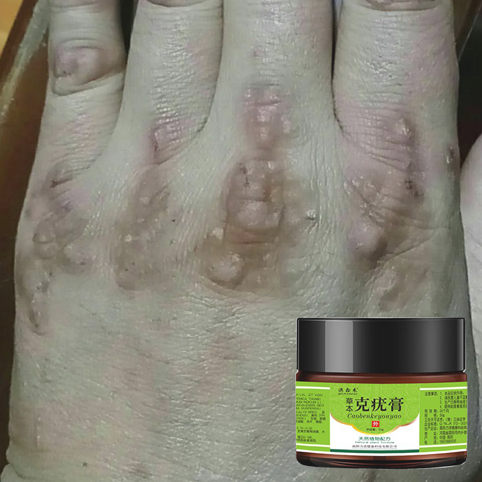 Kem tẩy mụn thịt wart,kem tri mụn,tẩy nốt ruồi,mụn cóc,kem loại bỏ mụn cóc,Mụn Thịt Dư,kem tẩy nốt ruồi