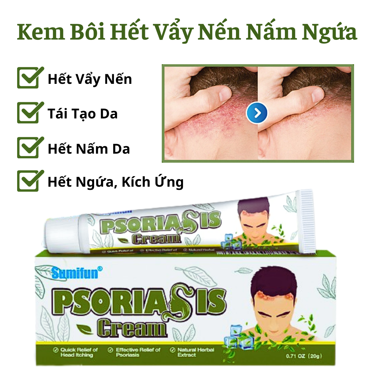 Kem Bôi Hết Vẩy Nến Á Sừng Nấm Ngứa Nổi Mẩn Trên Da 20g