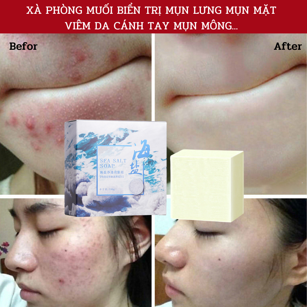 Xà Phòng Muối Biển Giúp Hết Bay Mụn Lưng Mụn Mặt Viêm Da Cánh Tay Mụn Mông Thu Nhỏ Lỗ Chân Lông Sea Salt Soap Handmade Từ Bọt Biển Sữa Dê