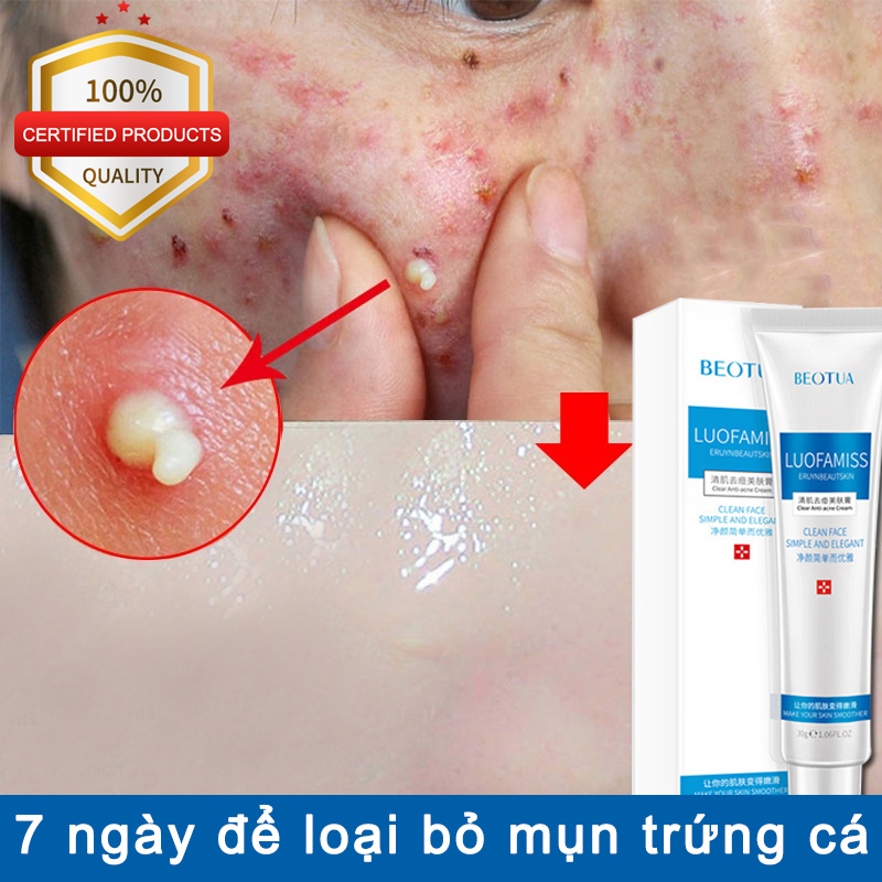 Kem Chính Hãng Loại Bỏ Mụn Thâm, Mụn Trứng Cá Ẩn, Gel chống mụn, Mụn ẩn, Gel xoá mụn nhanh chóng,kem ngăn ngừa mụn trứng cá hiệu quả cho nữ, xoá mụn hiệu quả, làm nhạt vết mụn, giảm mụn trứng cá, kiểm soát dầu 30g