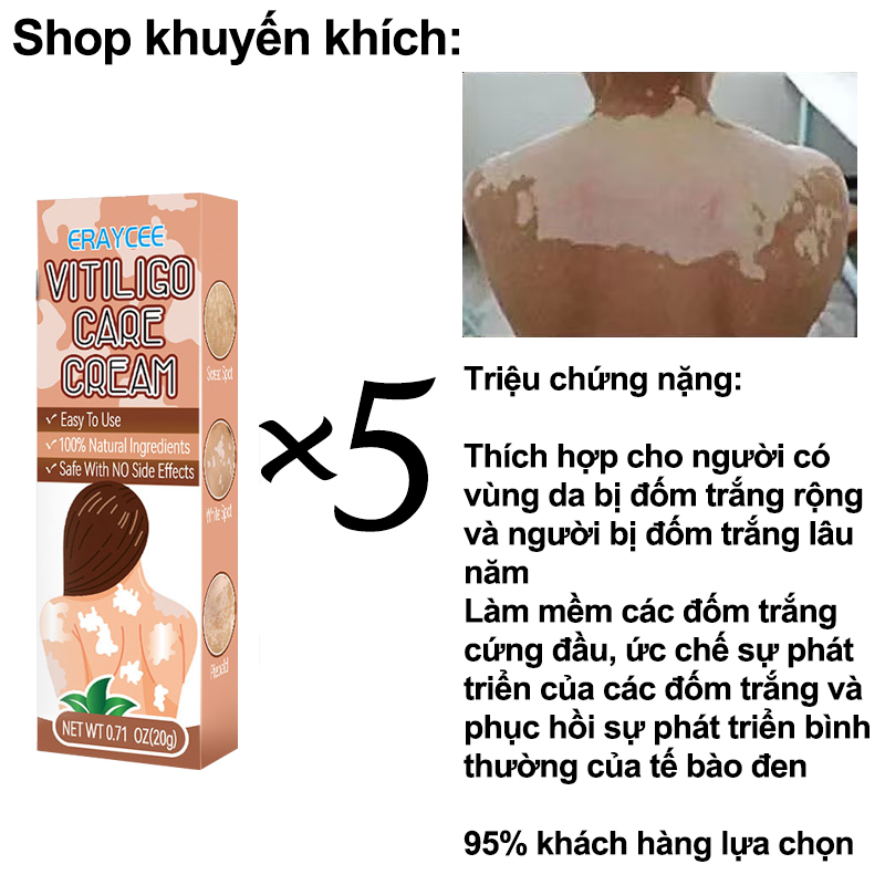 Kem Bôi Chống Khuẩn Lang Ben Hắc Lào Loại Bỏ Bạch Biến Lang Ben Dịu Nhẹ Không Kích Ứng Thúc Đẩy Tăng Trưởng Hắc Tố Tái Tạo Da 20G