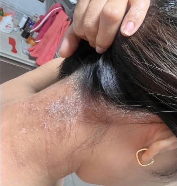 Bôi Vẩy Nến, Á Sừng Da Đầu, Nấm Da đầu kem Cải thiện các vấn đề Da Liễu Ngứa bong chóc