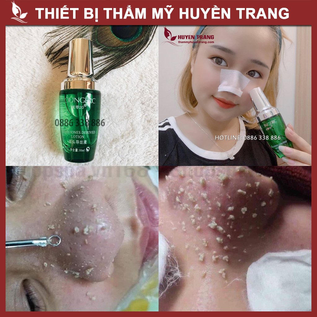 Ủ Mụn Đầu Đen YOUNGERC 30ml Chính Hãng Chuyên Dùng Cho Spa Thẩm Mỹ Viện Huyền Trang NANOCEE