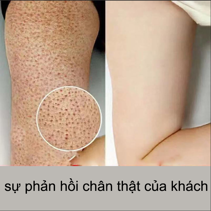Dạng hạt giúp tẩy sạch tới từng tế bào –tẩy tế bào chết da mặt Tẩy Tế Bào Chết Peeling Gel Kem tẩy da chết, tẩy tếlàm trắng da Tẩy tế bào chết