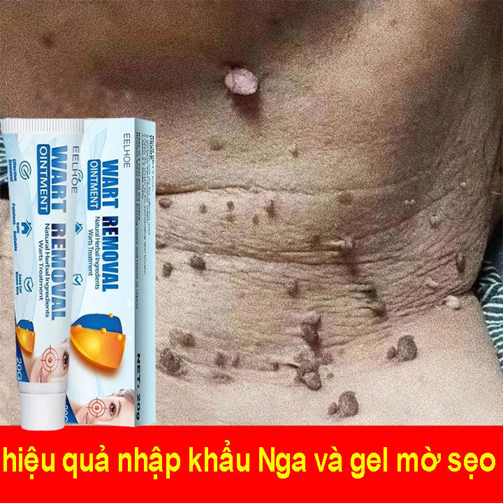 （COD）Kem tẩy mụn cơm, loại bỏ mụn cóc kem loại bỏ mụn cơm phiên bản gốc, kem loại bỏ mụn cóc Loại bỏ hiệu quả mụn cóc thông thường, mụn cóc phẳng, mụn cóc dạng sợi, mụn cóc, tuýp 20g