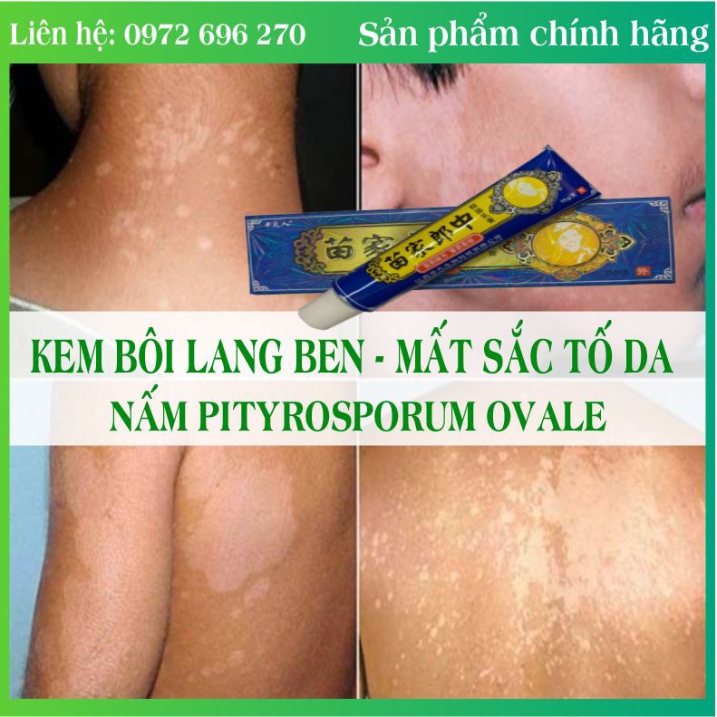Kem bôi lang ben - mất sắc tố da hết sạch lang ben sau 3 ngày