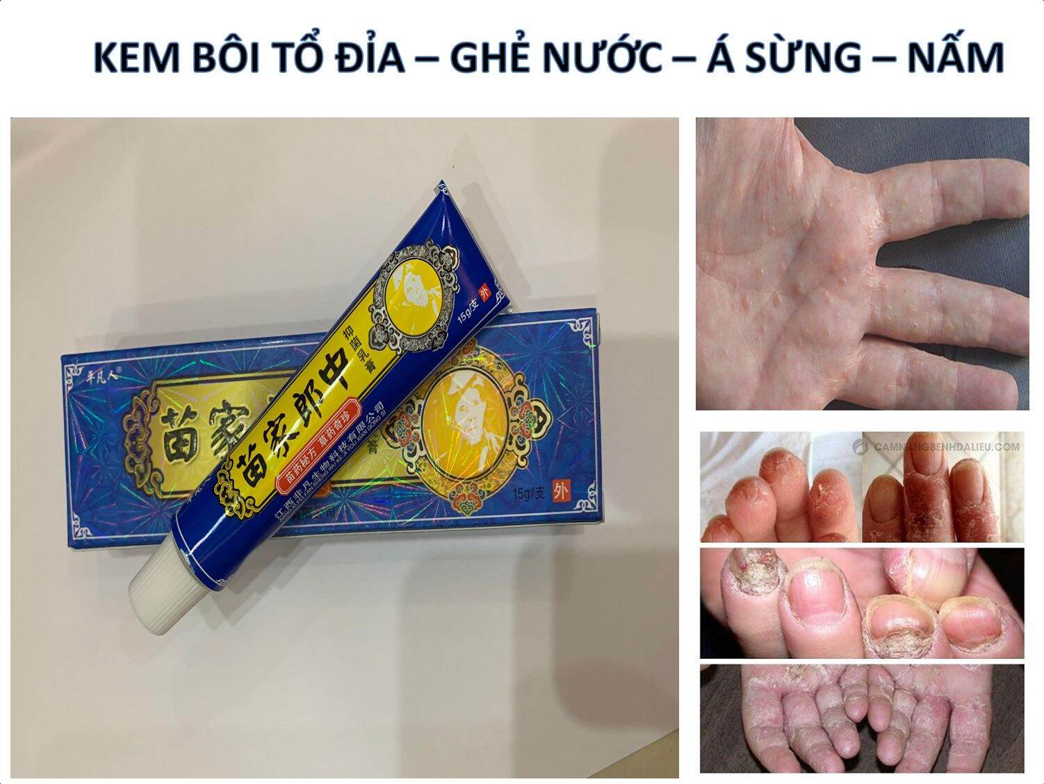 Kem bôi đông y thảo dược nấm ngứa 15g