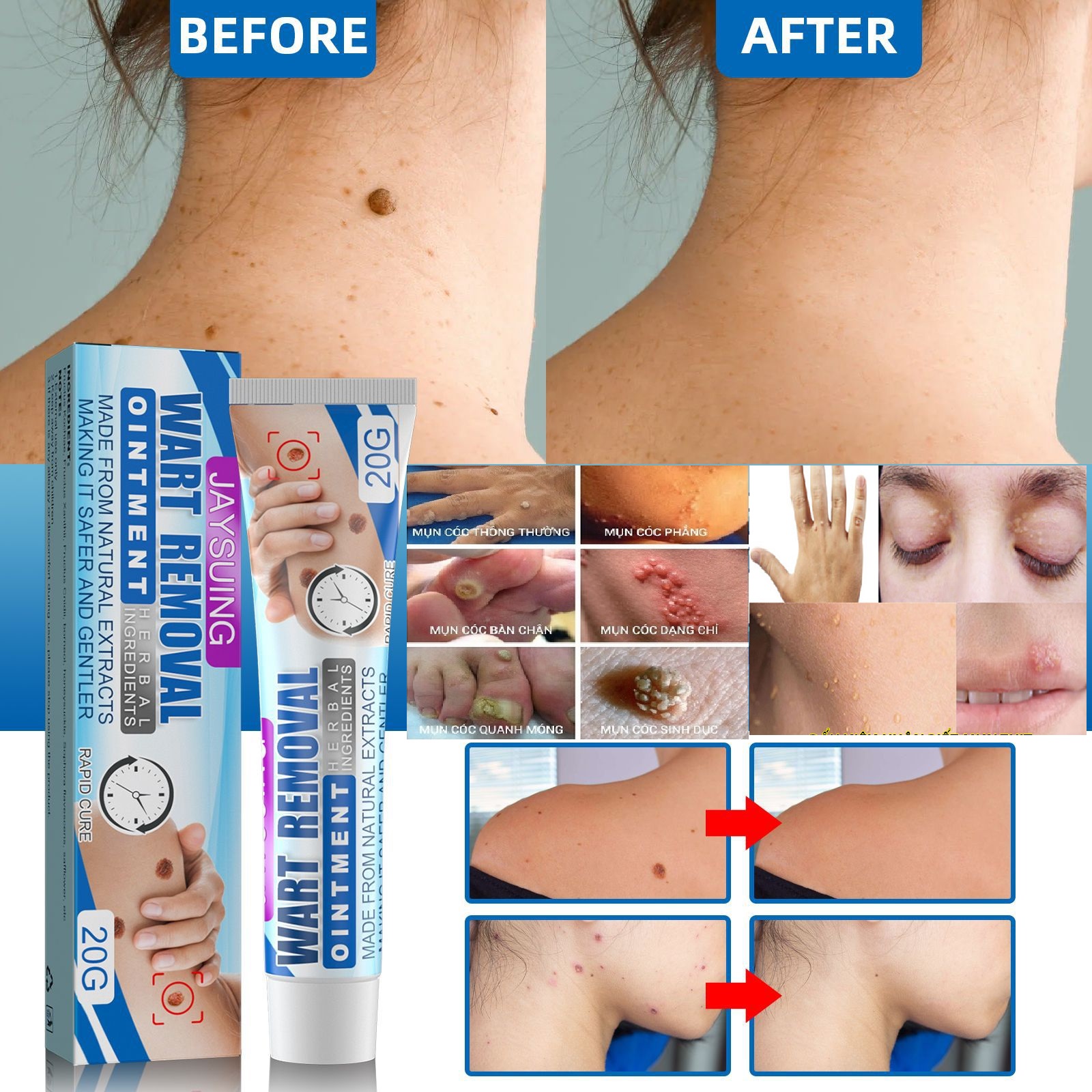 Kem Bôi Xóa Mụn Thịt, Thịt Thừa, Mụn Cóc, Nốt Ruồi Không Đau, Ngứa, Không Tổn Thương Da 20g