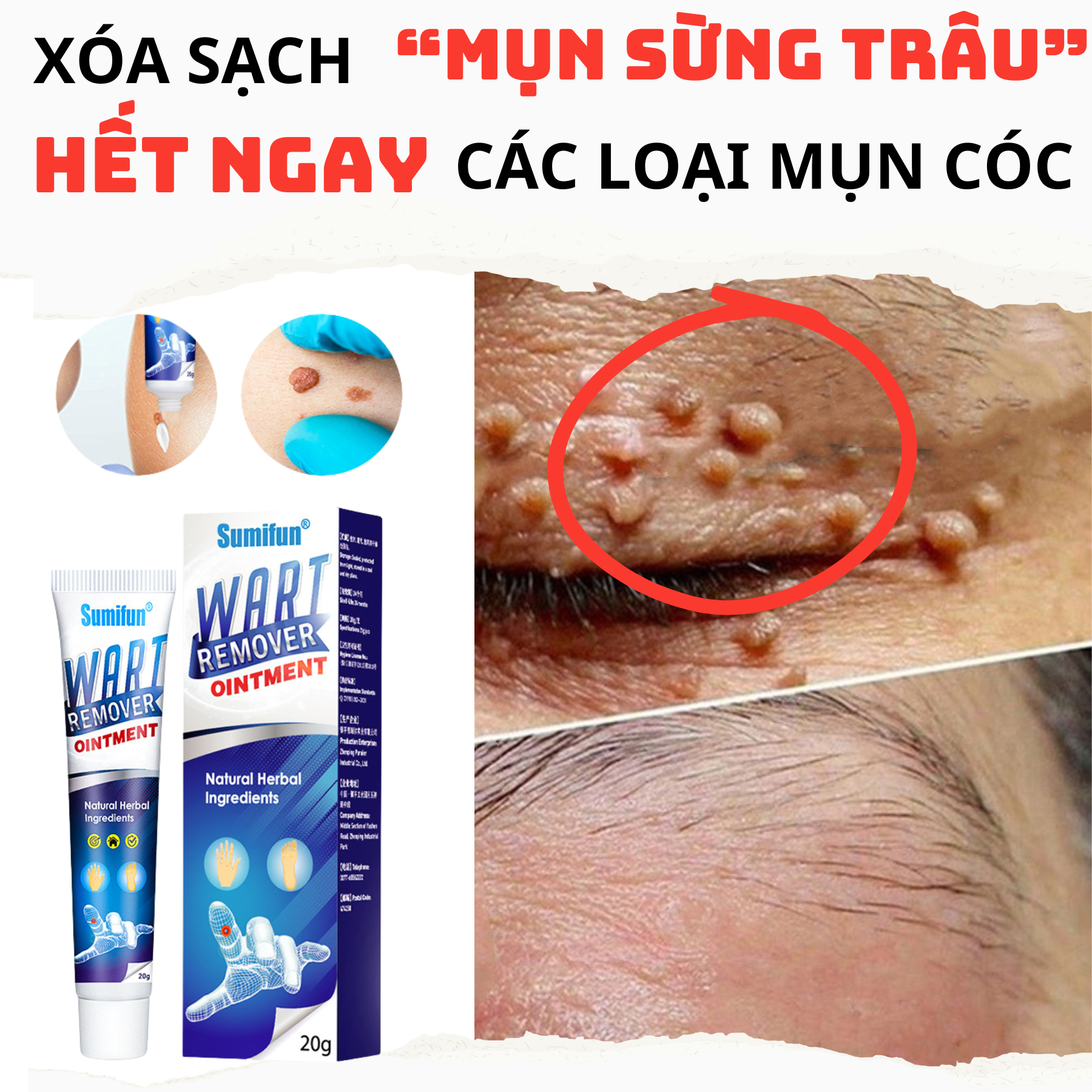 Kem tẩy nốt ruồi - gel tẩy mụn thịt mụn cơm mụn cóc thịt thừa an toàn hiệu quả sumifun cam kết 100% chính hãng 3-5 ngày rụng sạch mụn