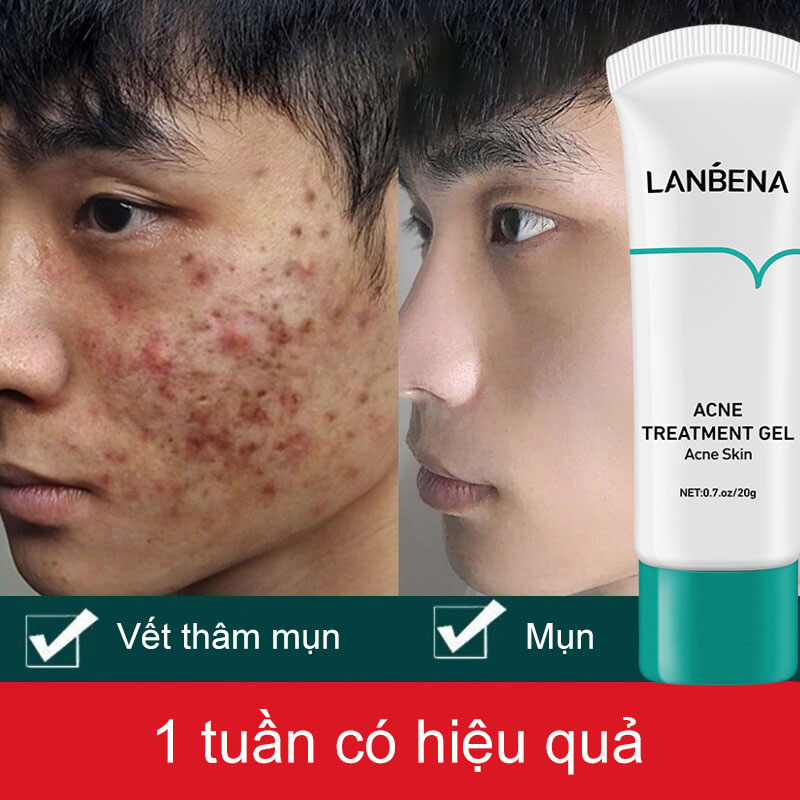 Kem sạch mụn phục hồi sẹo mụn trứng cá sẹo lõm gel làm mờ thâm mụn kem sạch mụn trứng cá mụn cám tuổi dậy thì