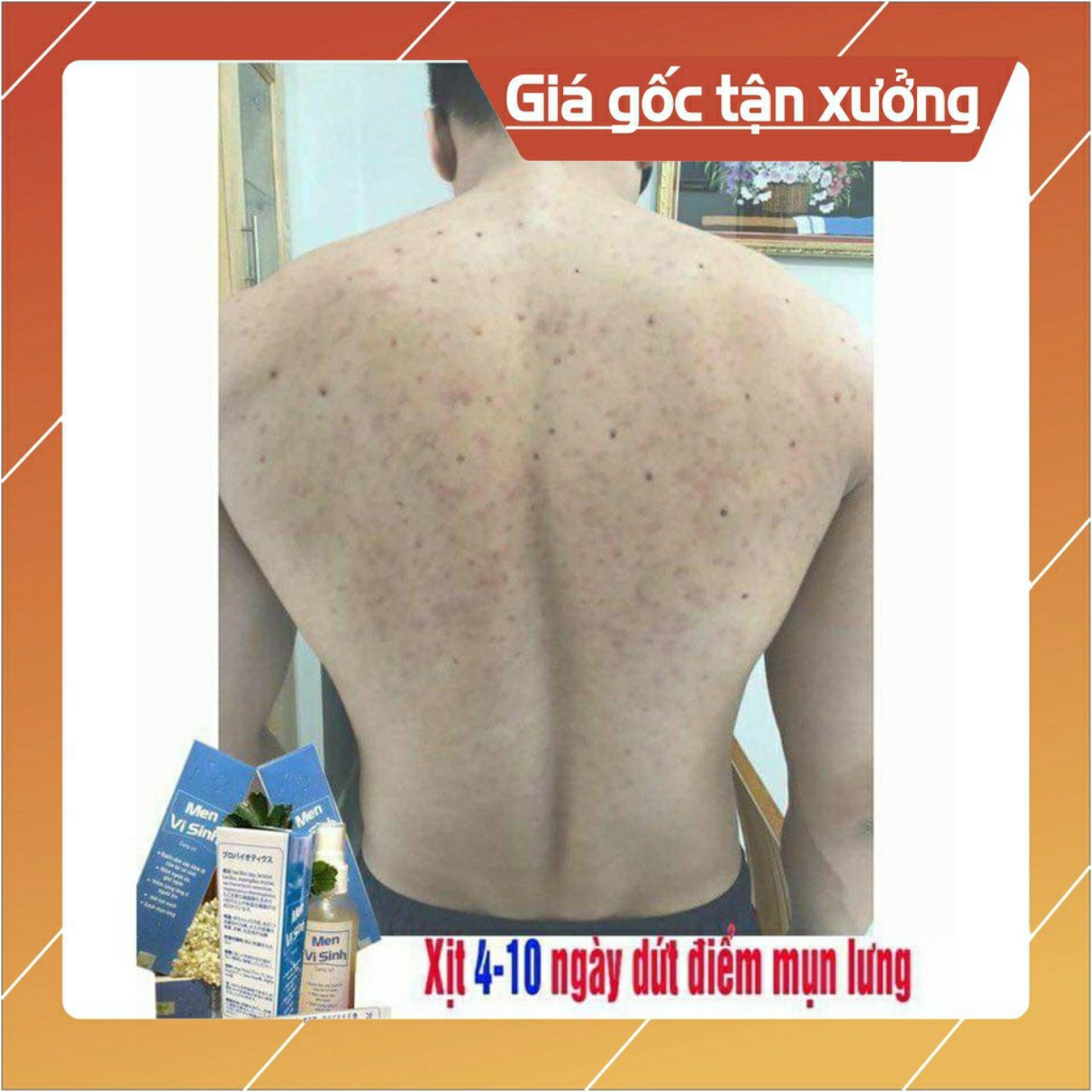 giảm giá sốc - DỨT ĐIỂM VIÊM NANG LÔNG, MỤN LƯNG NGỰC, VIÊM DA  hết dứt điểm sau một liệu trình sd