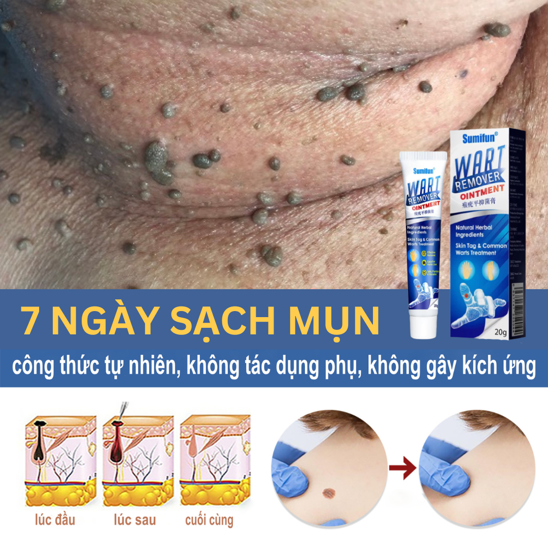 {ĐÁNH BẬT} Kem bôi rụng hết mụn cócmụn thịt mụn cơm mụn ruồi nám tàn nhang bay hết nhanh trong vong một nốt nhạc lọ 20g HÀNG CHUẨN chính hãng loại bỏ mụn trâu gây khó chịu.