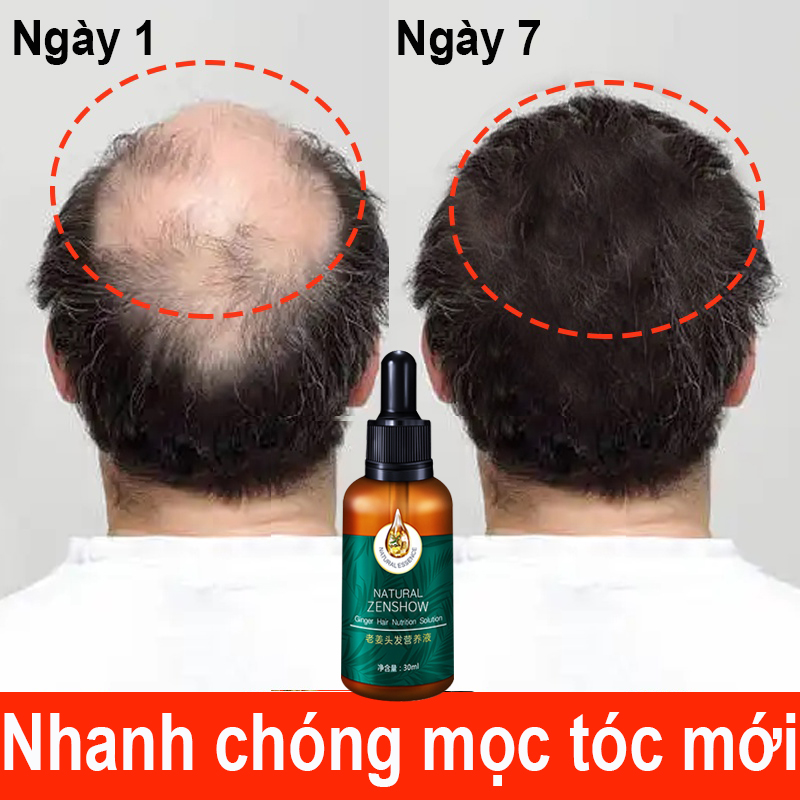 Tinh dầu kích mọc tóc nhanh ngăn 30ML Kích thích tăng trưởng tóc dày nhanh để ngăn ngừa rụng tóc