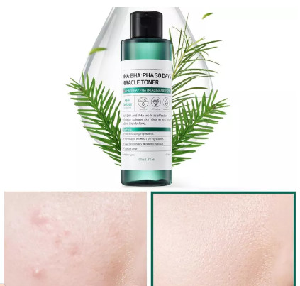 Nước hoa hồng giảm mụn some by mi aha-bha-pha 30 days miracle tonernước hoa hồng làm sạch mụn some by mi aha-bha-pha 30 days miracle toner 150ml