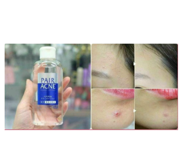 Nước hoa hồng ngăn ngừa, giảm mụn PAIR Nhật Bản 160ml- PAIR ACNE 160ML