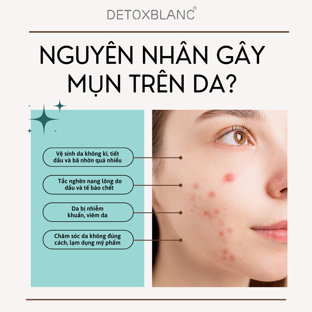Serum Mụn Lộc Đề H 30ml - Peel Acnes Blanc H