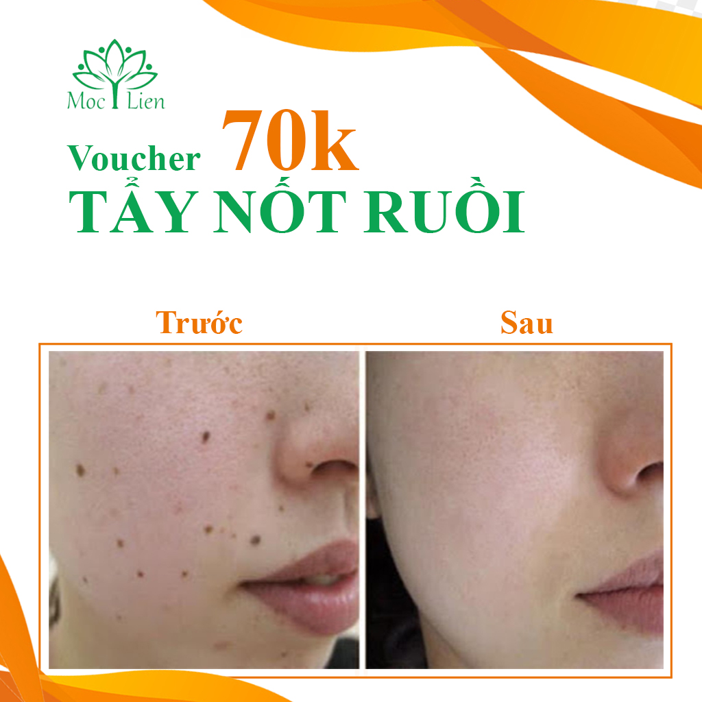 HCM - Voucher Spa - Đốt Nốt Ruồi - Mụn Thịt - Mụn Gạo tại TM Mộc Ý Liên