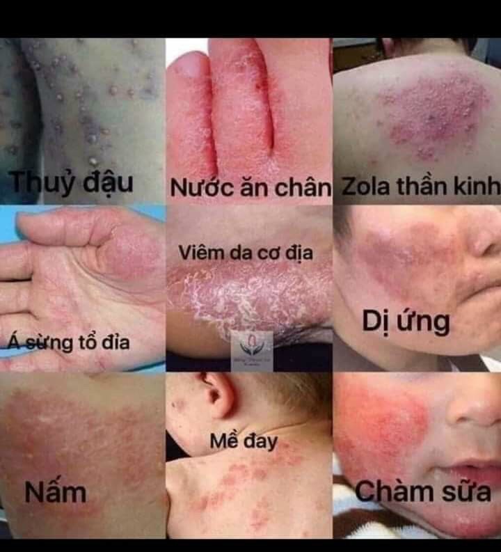 Kem bôi ngoài da HUOJIANDUI YiJun Rugao 18gr chuyên hỗ trợ giảm nấm các loại hắc lào vảy nến á sừng nưt ne ngứa ngoài da TOP 10 LOẠI kem bôi ngoài da tốt nhất Trung Hoa 1