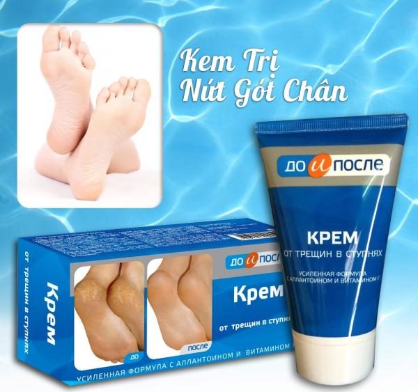 Kem làm mềm và giảm thiểu nứt gót chân Kpem hàng nội địa Nga