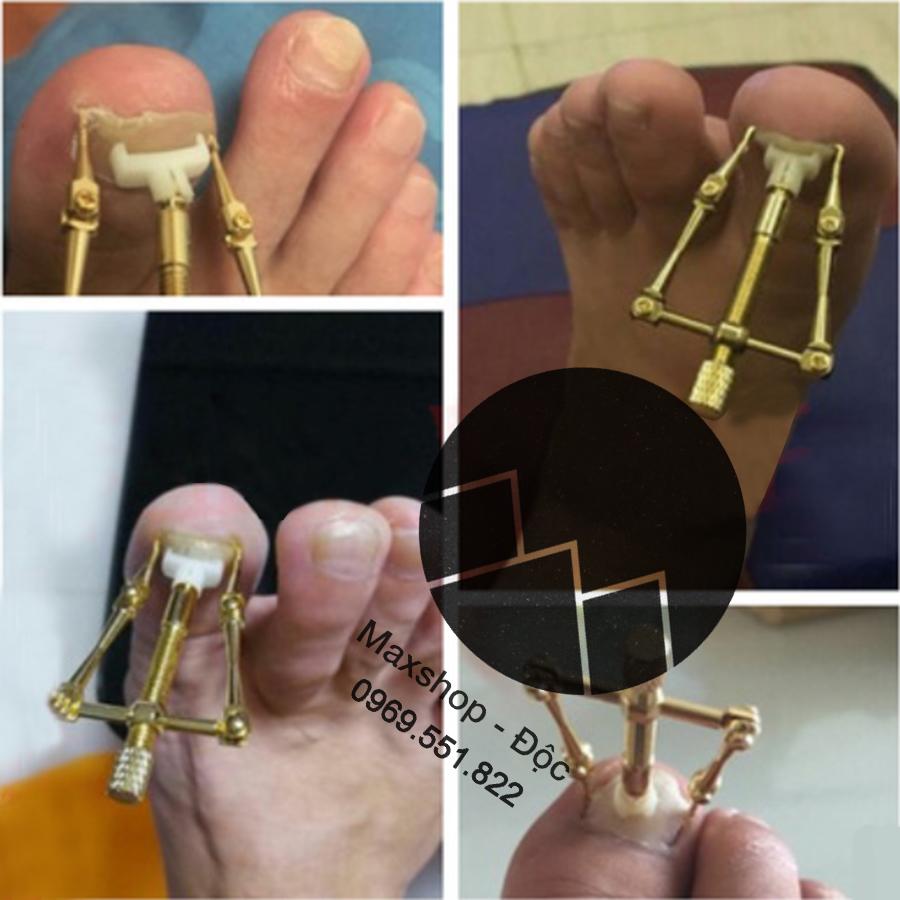 Dụng cụ chữa móng chân chọc thịt