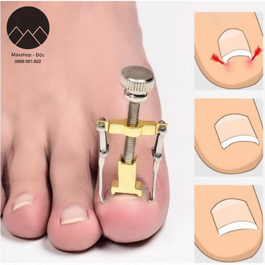 Dụng cụ chữa móng chân chọc thịt