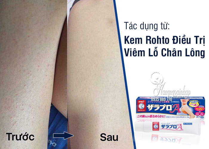 Kem bôi viêm nang lông của Nhật (35g)