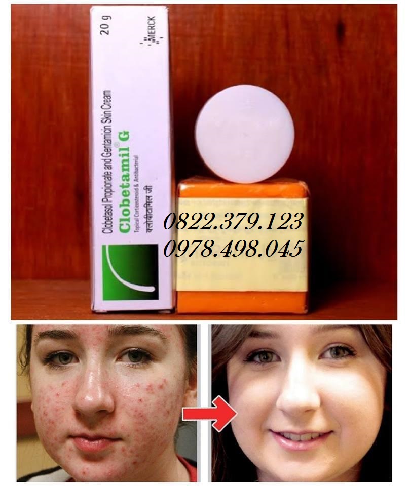 Bộ clobetamil g nám, tàn nhang thái lan