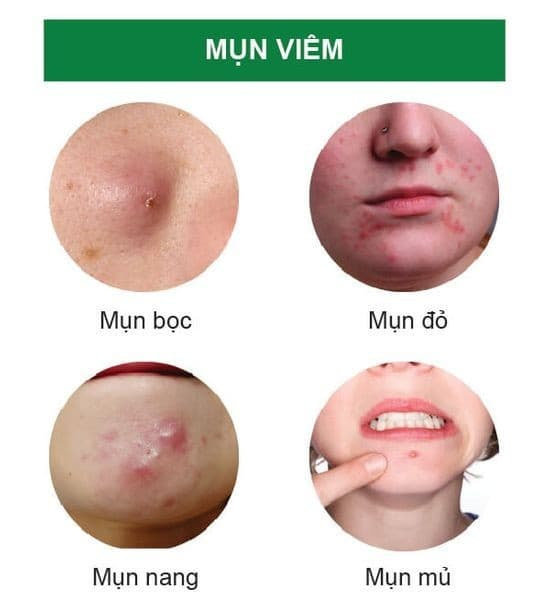 Kem Mụn Dr SKIN ACNE