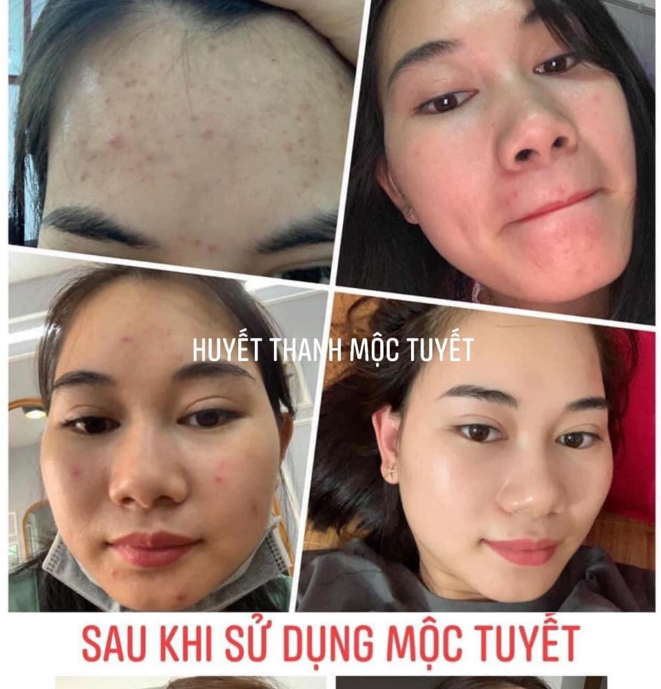 Chính Hãng Huyết thanh Mộc Tuyết,xoá mụn,thâm,trắng da tái tạo làn da 4