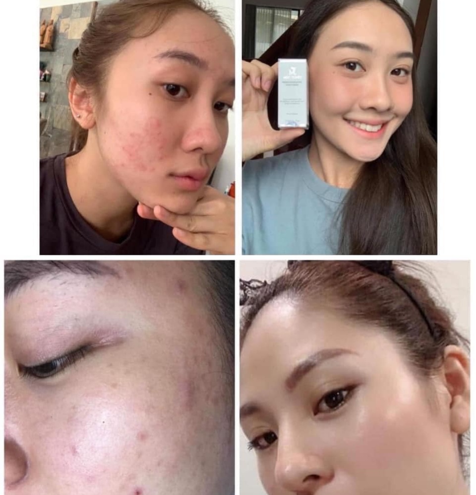 Chính Hãng Huyết thanh Mộc Tuyết,xoá mụn,thâm,trắng da tái tạo làn da 5
