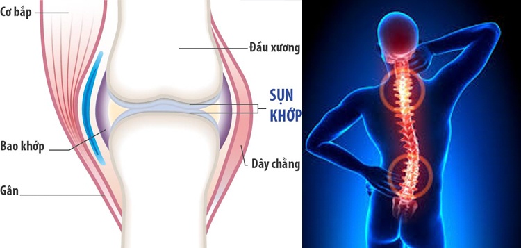 Thoát vị đĩa đệm xương khớp